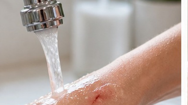 A small hand wound being rinsed under clean running water